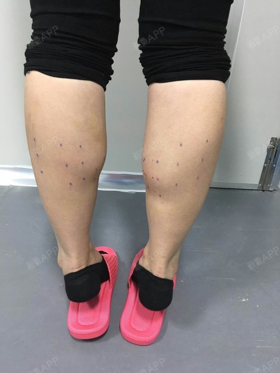 注射瘦小腿好不好_效果图_美丽女人最好命注射瘦小腿术后第6天_新氧