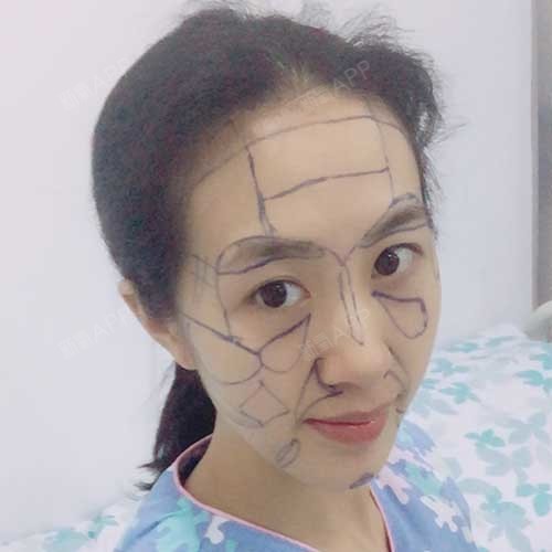 my_soso自体脂肪全脸填充第0天美丽日记