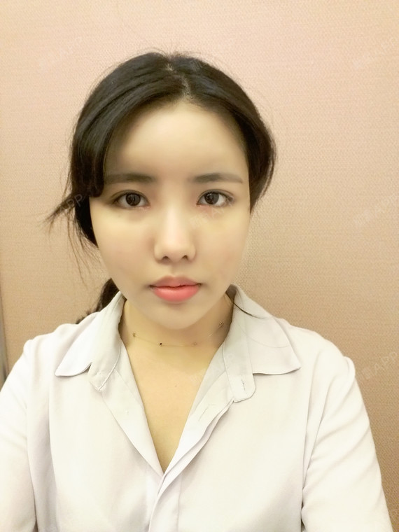 自体脂肪全脸填充好不好_效果图_ò夏天吃了春天自体脂肪全脸填充术后