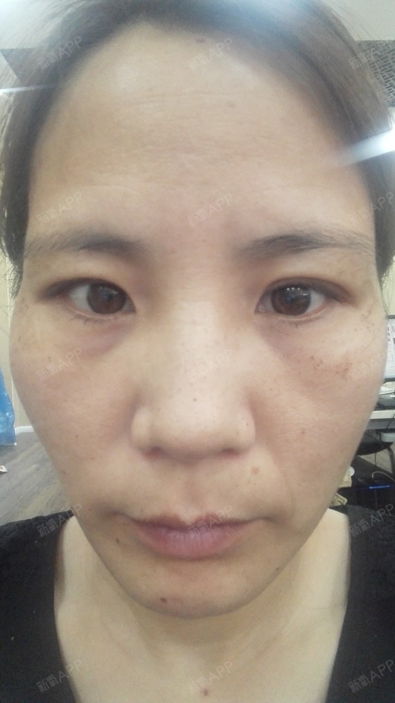 【北京三仁强脉冲光祛斑第五天】大家好,我来喽,做完_圈子-新氧美容