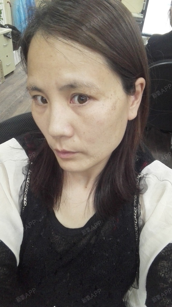 【北京三仁强脉冲光祛斑第五天】大家好,我来喽,做完_圈子-新氧美容