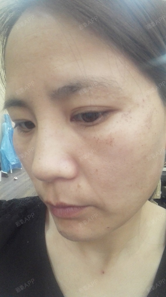 【北京三仁强脉冲光祛斑第五天】大家好,我来喽,做完_圈子-新氧美容