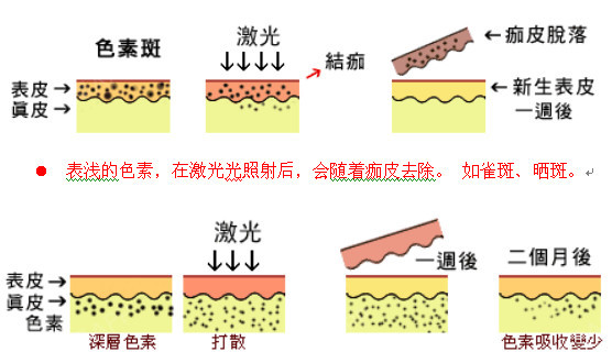 個別患者術後可能出現正常的暫時性色素沉著,會逐漸代謝,恢復正常.