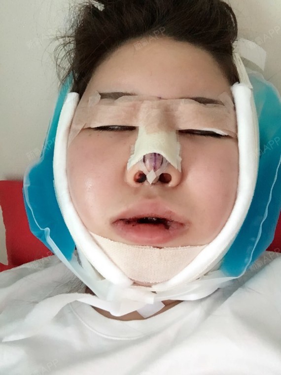 手术部位:下巴和鼻子