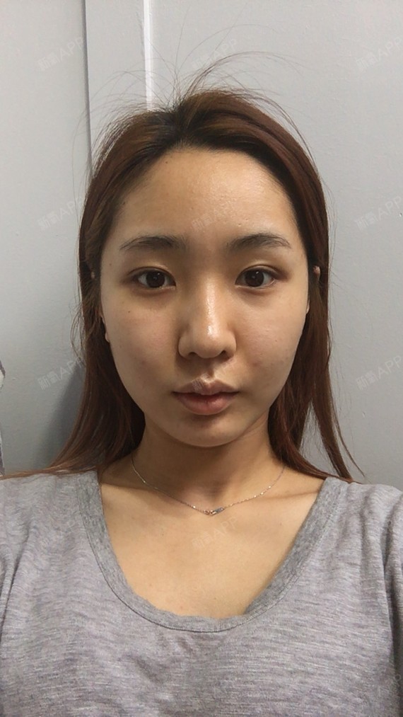 硅胶垫下巴好不好_效果图_硅胶垫下巴术后第0天_新氧美容整形