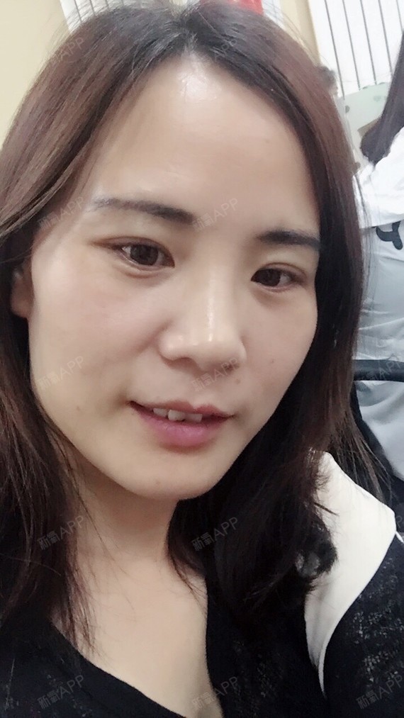 【北京三仁强脉冲光祛斑 祛痣14天】