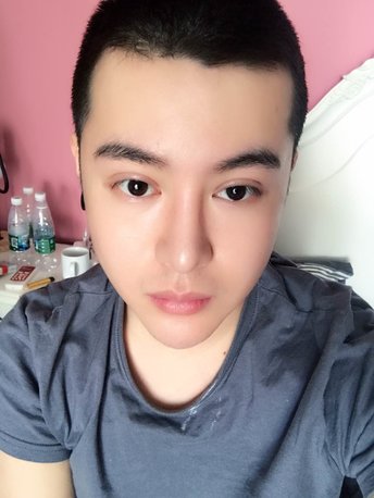 合集·开外眼角 切开双眼皮 眼.