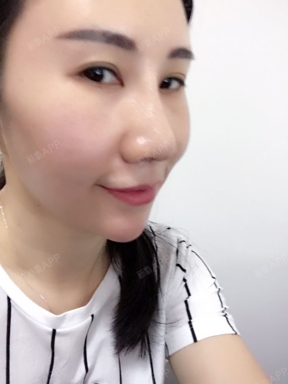 做完线雕隆鼻第8天,鼻子没有任何不适,鼻头那里有个_圈子-新氧美容