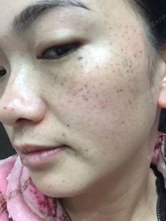 激光祛斑第3天的照片,脸上黑点点有点痒,又不能挠,_圈子-新氧美容整形