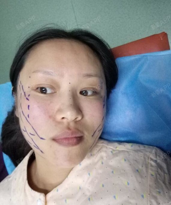 早就听说现在线雕美容很火,但真的没有想到会这么火哈,手术都