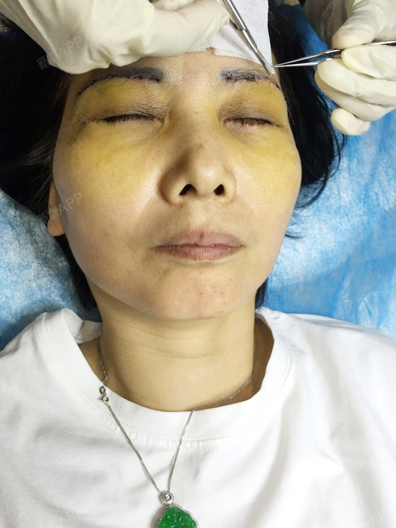 这个是第7天拆线的照片.做完肿了3天左右,就开始消_圈子-新氧美容整形