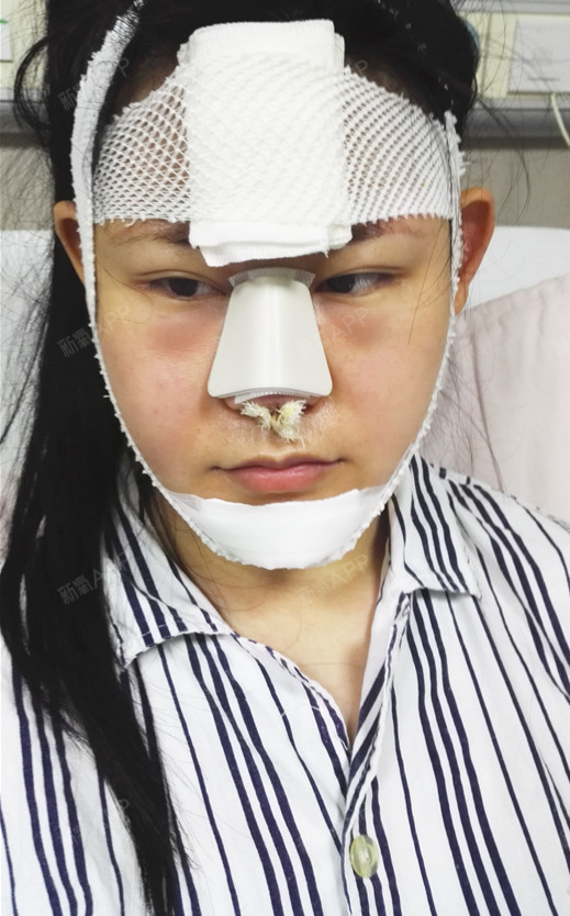 术后第1天,眼睛有些肿,下巴鼻子包扎的很严实,躺床上休息