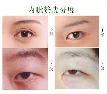 一般来说,亚洲人都有轻重不同的内眦赘皮,开眼角能使重睑线延长并增加