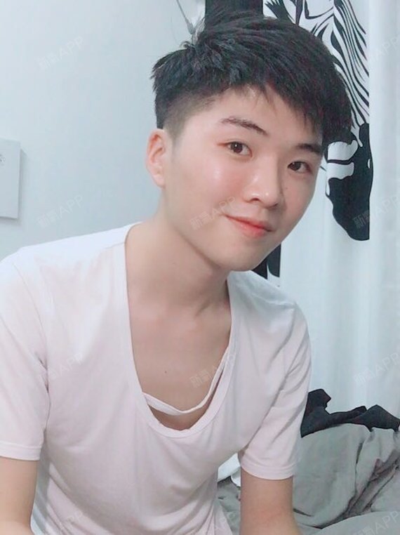 自体脂肪丰苹果肌好不好_效果图_煎饼侠朋自体脂肪丰苹果肌术后第17天