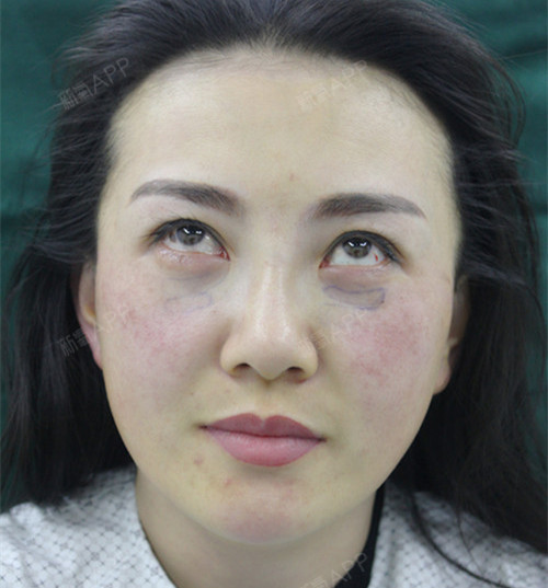 北京内切去眼袋好不好_效果图_榆荚自芳菲Ⅱ内切去眼袋术后第0天_新氧