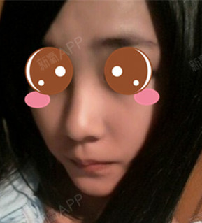 你想咋的激光祛斑第31天美丽日记-新氧美容整