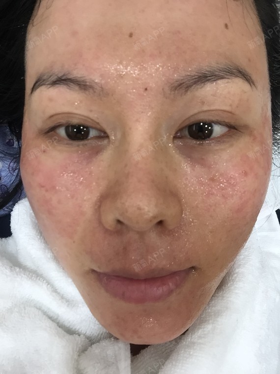 水光补水好不好_效果图_予以时光以深爱水光补水术后第0天_新氧美容