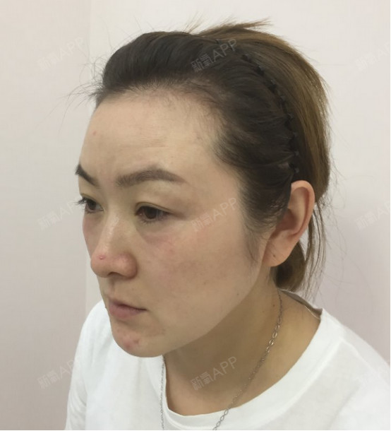 【北京三仁整形爱贝芙隆鼻术后0天】