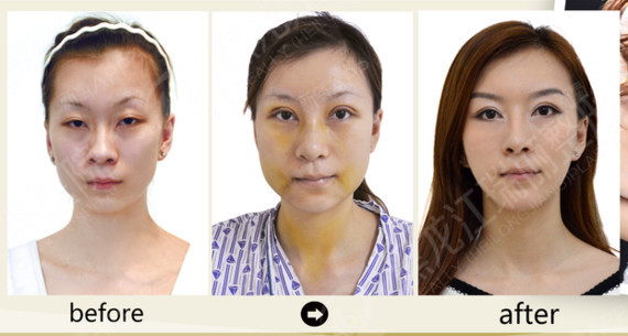 生活中一定会有很多先天发育不良平胸的妹子,被人戏称_圈子-新氧美容