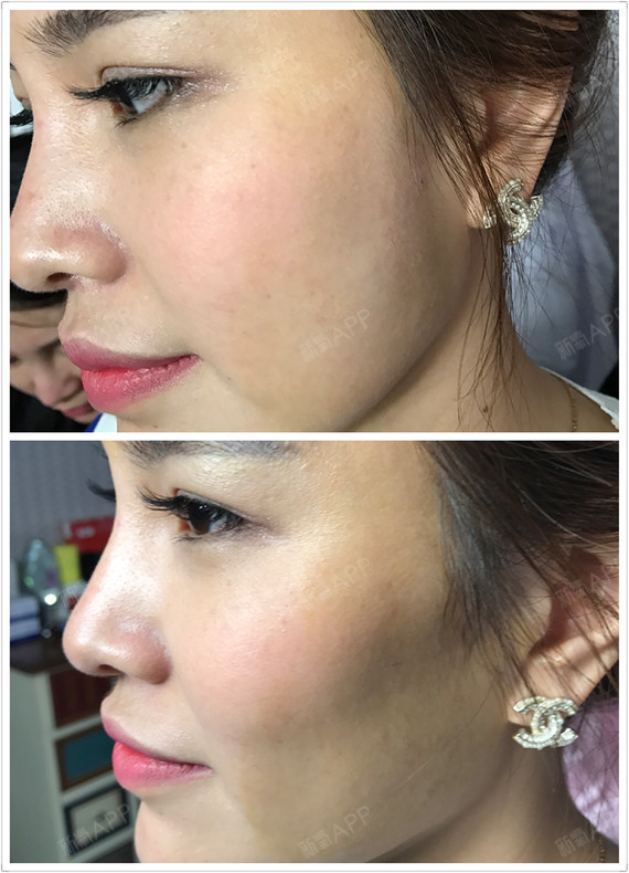 今天是注射玻尿酸丰太阳穴的第一天,昨天下午1点多注_圈子-新氧美容