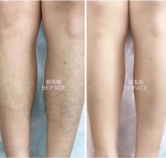 超冰点脱毛,效果不错!