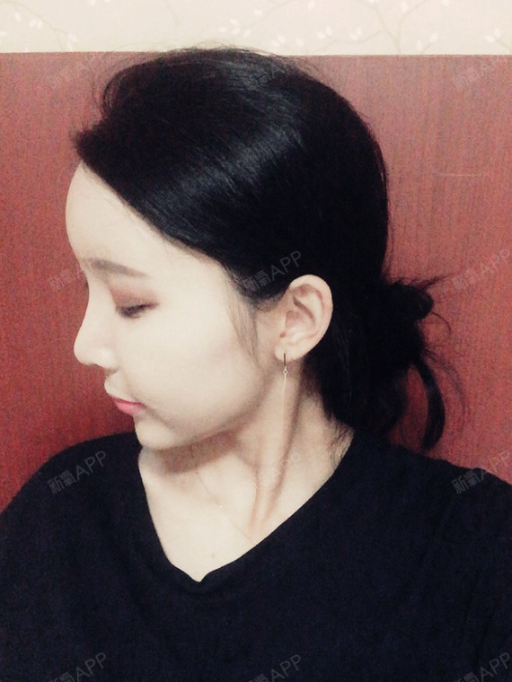 额头超级饱满,_圈子-新氧美容整形