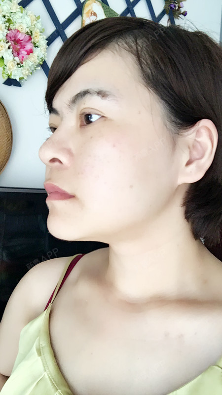 瘦脸针的效果我觉得现在已经很明显了,我咬肌是比较大的那种,前几天几