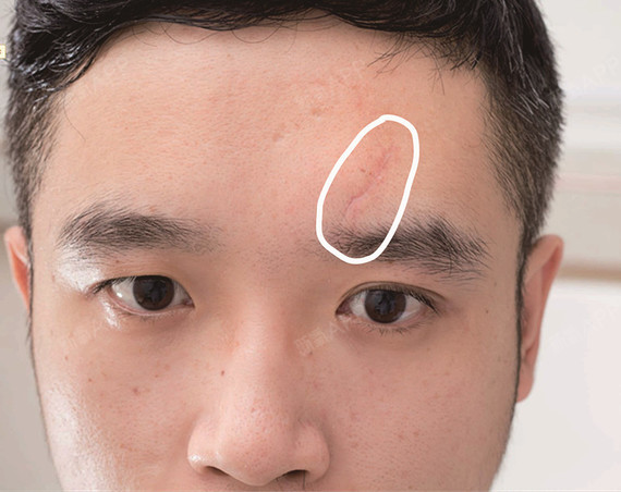 长时间泡在新氧网,看很多人为痘坑疤痕发愁,我觉得是_圈子-新氧美容