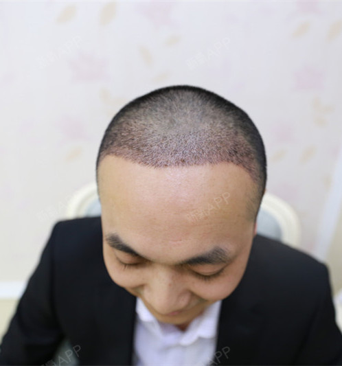 一个周了,发际线确实比较明显,也看不出什么植发痕迹_圈子-新氧美容