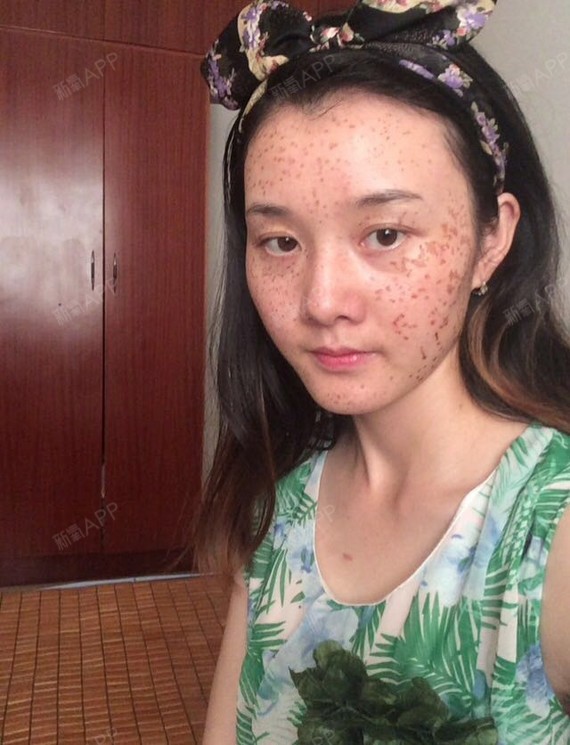 重庆激光祛斑好不好_效果图_菲儿宝宝美美嗒激光祛斑术后第5天_新氧