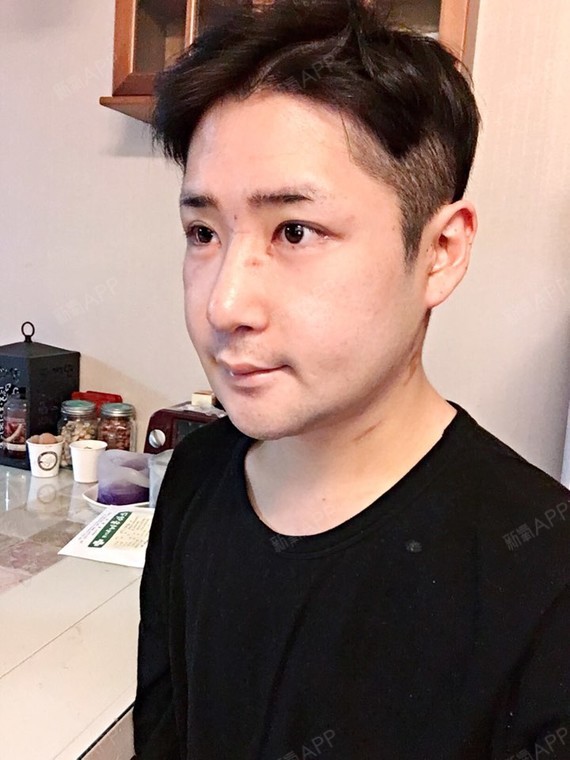 埋线双眼皮好不好_效果图_霸道yu埋线双眼皮术后第61天_新氧美容整形