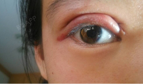 疤痕体质可以做双眼皮吗