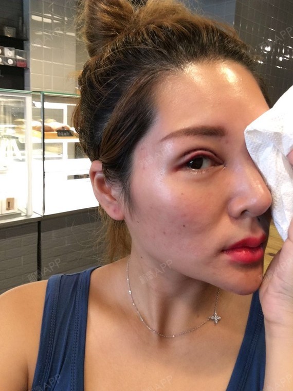 眼综合术后第一天,眼睛有点疼,但是在忍受范围内.