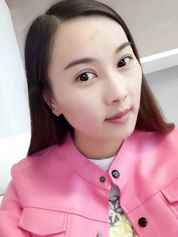 双眼皮好不好_效果图_氧气ijj4a7f切开双眼皮术后第10天_新氧美容整形