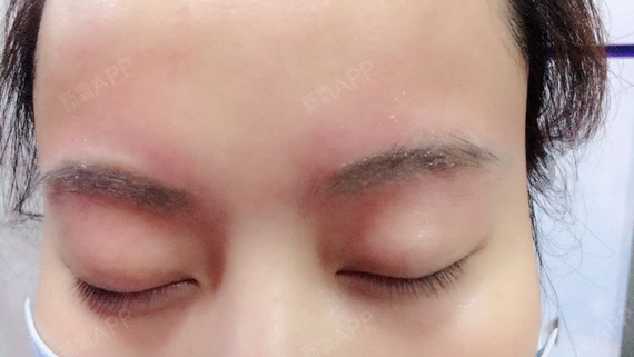 敷了10分钟麻药就做皮秒洗眉了,做完才知道麻药敷的时间太短