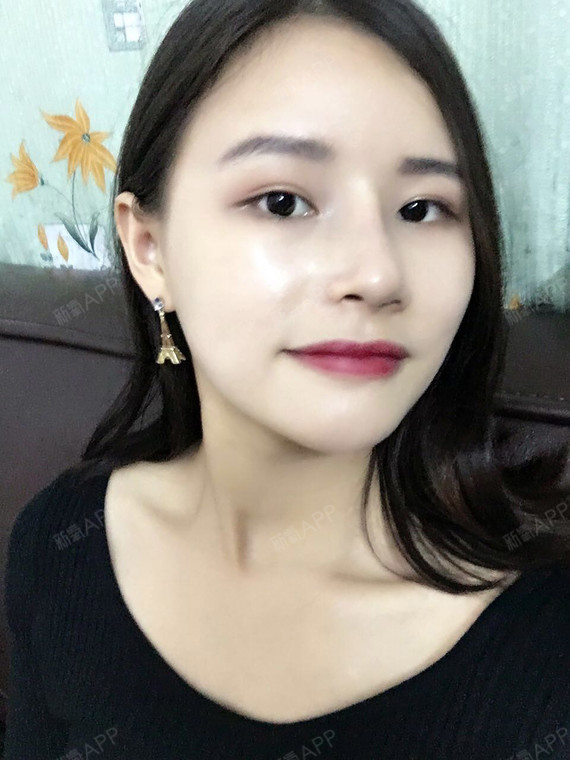 【广州珈禾整形海鸥鼻部多项术后】鼻子感觉越来越自然好_圈子-新氧