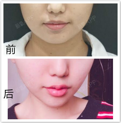 我的嘴角上扬,不评价,可以看效果_圈子-新氧美容整形