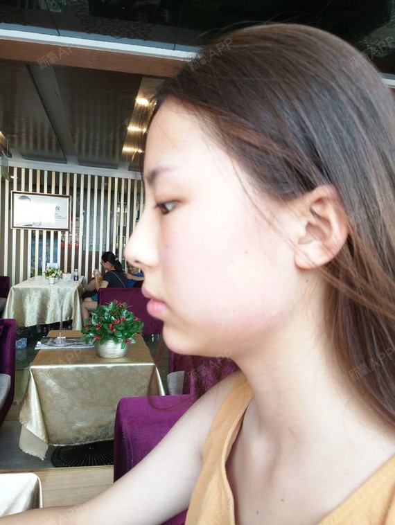 合肥玻尿酸垫下巴好不好_效果图_氧气o3p6b11玻尿酸垫下巴术后第0天