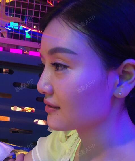 玻尿酸隆鼻维持多久_玻尿酸维持隆鼻效果多久_玻尿酸隆鼻可以维持一辈子吗