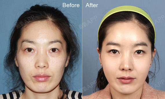 面部凹陷脱相似鬼怪饱满圆润才最美