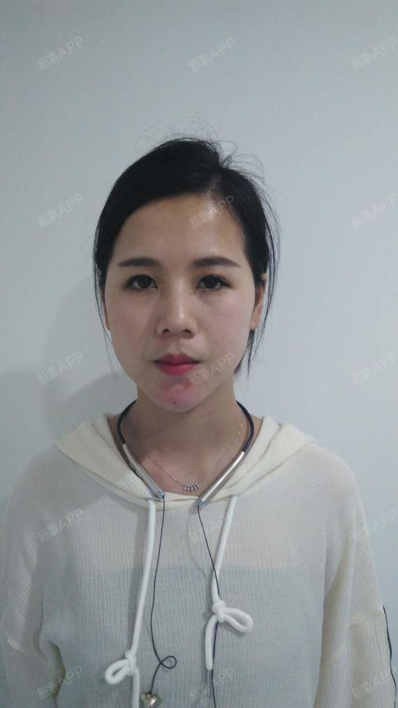 刚注射了伊婉玻尿酸注射下巴第3天了哦,刚注射完效果_圈子-新氧美容