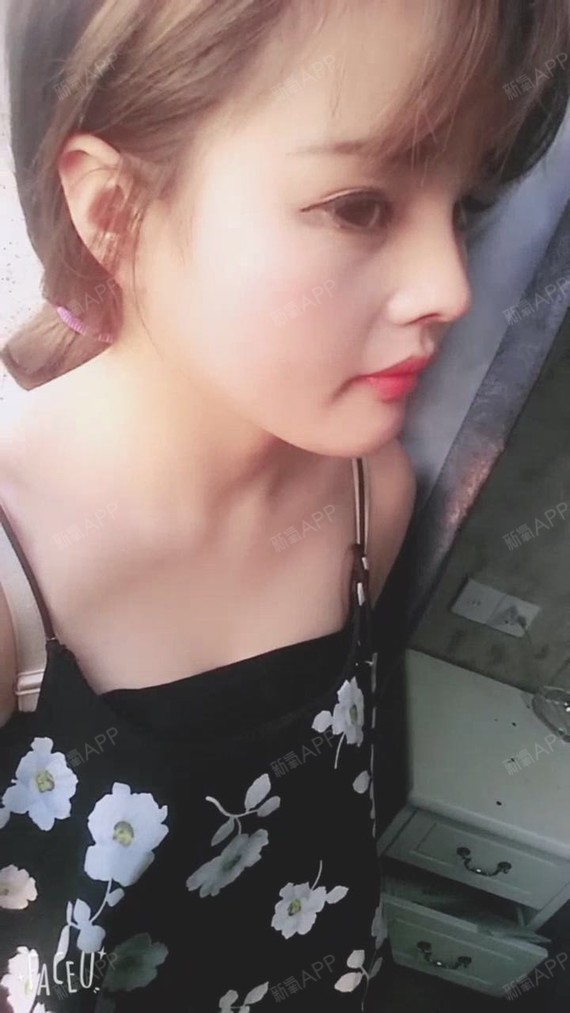 杭州膨体隆鼻好不好_效果图_欣欣之心膨体隆鼻术后第78天_新氧美容