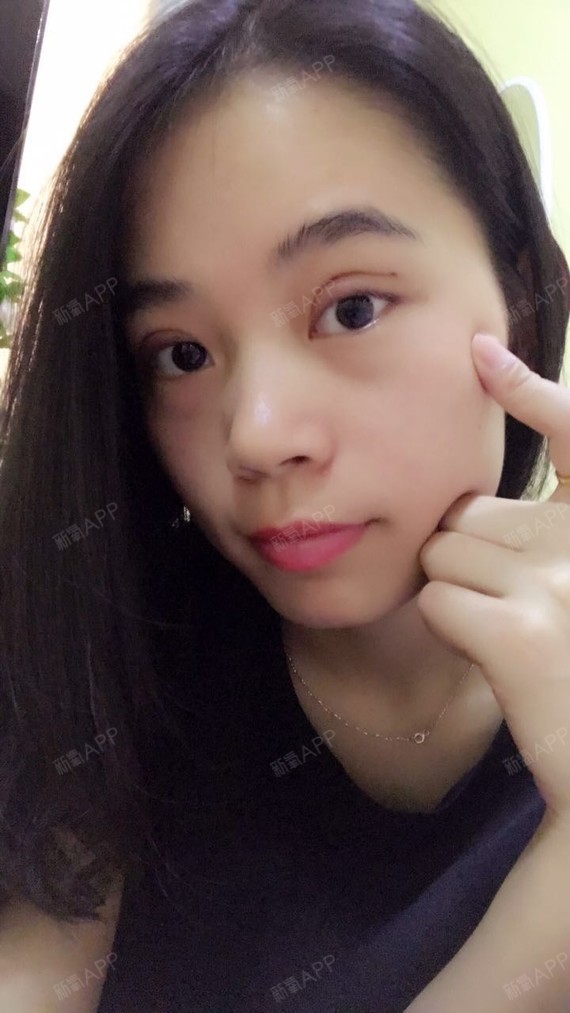 做完双眼皮一周,眼睛恢复成正常肤色了,真的只有一条_圈子-新氧美容