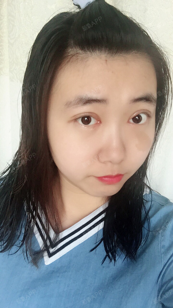 埋线双眼皮