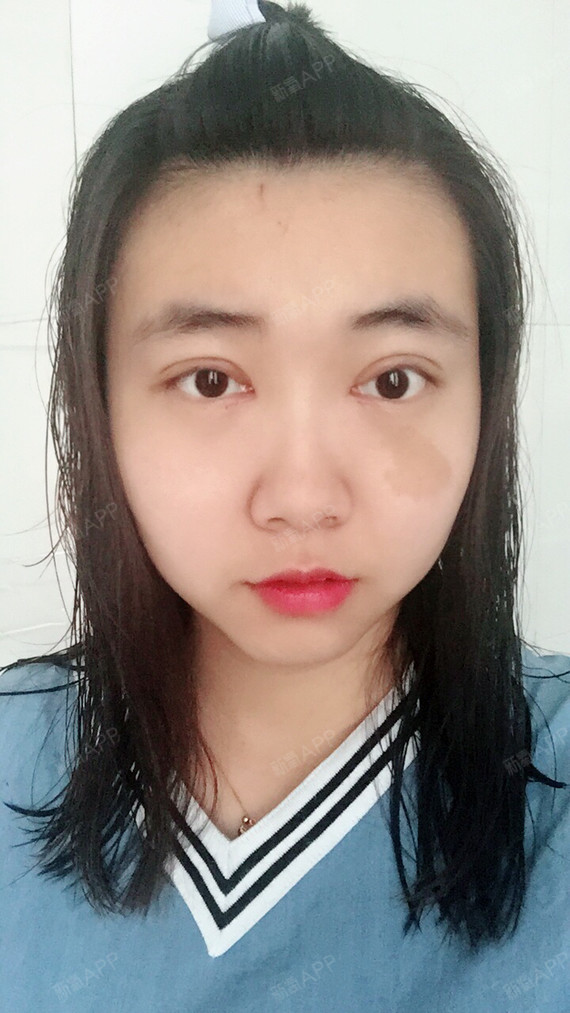 埋线双眼皮