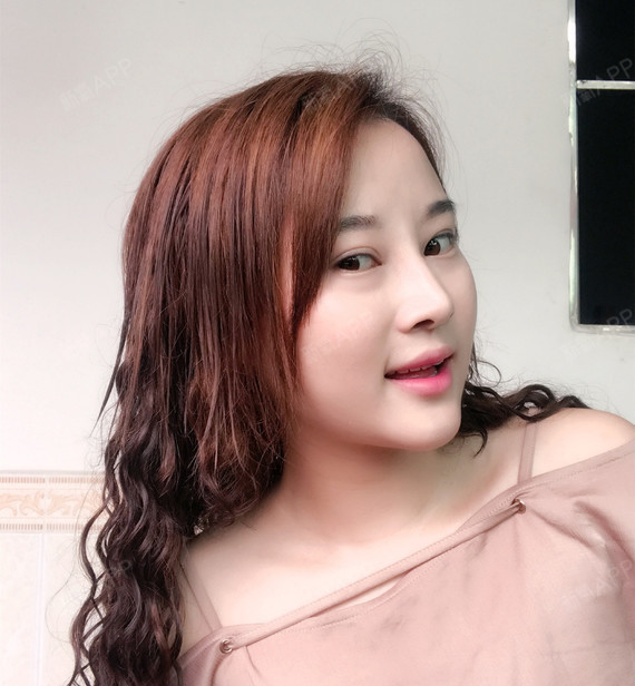 梨涡lw鼻综合术后第26天美丽日记_新氧整形