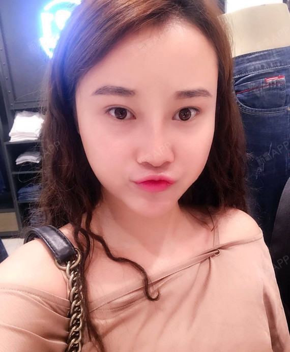 梨涡lw鼻综合第26天美丽日记-新氧美容整形