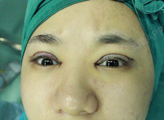 小眼睛,上睑下垂,轻度内眦赘皮如何通过双眼皮手术拥_圈子-新氧美容