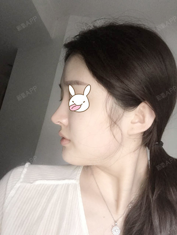 其实现在也恢复的不错呢!侧面鼻子的弧度真的很喜欢.
