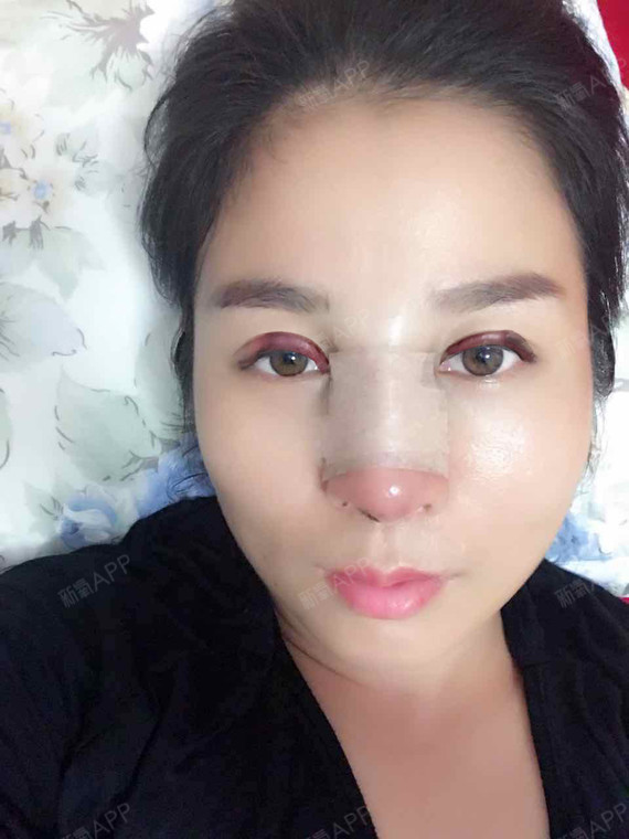 今天眼睛肿起来了,鼻子也肿,整个人肿得跟个猪头一样_圈子-新氧美容